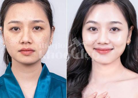 Trị nám hỗn hợp tận gốc – Công nghệ mới, an toàn, hiệu quả bền lâu - 5/6