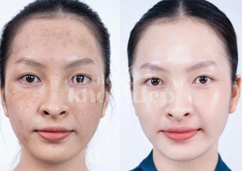 Trị nám hỗn hợp tận gốc – Công nghệ mới, an toàn, hiệu quả bền lâu - 6/6