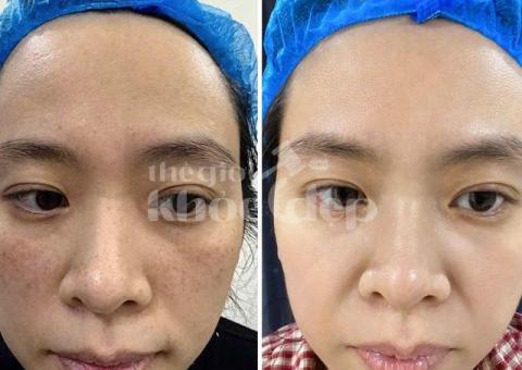 Điều trị nám da an toàn – Hiệu quả tận gốc, trẻ hóa làn da - 4/5