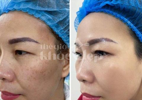 Điều trị nám da an toàn – Hiệu quả tận gốc, trẻ hóa làn da - 5/5