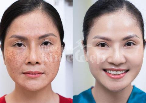 Dịch vụ trị nám da công nghệ cao – An toàn, hiệu quả, không tái phát - 3/4