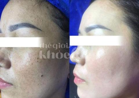 Trị nám mảng lâu năm – Giải pháp công nghệ cao an toàn, hiệu quả bền vững - 1/5