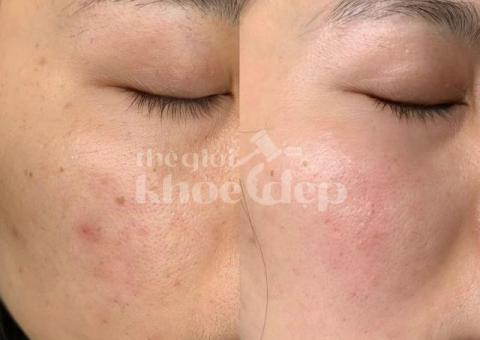 Trị nám mảng lâu năm – Giải pháp công nghệ cao an toàn, hiệu quả bền vững - 4/5