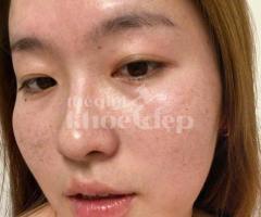 Trị nám hỗn hợp và tàn nhang – Giải pháp công nghệ cao, hiệu quả toàn diện