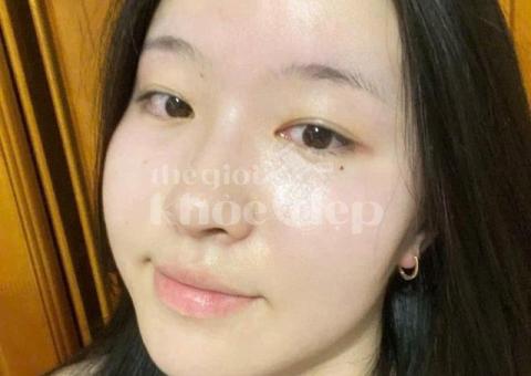 Trị nám hỗn hợp và tàn nhang – Giải pháp công nghệ cao, hiệu quả toàn diện - 2/3