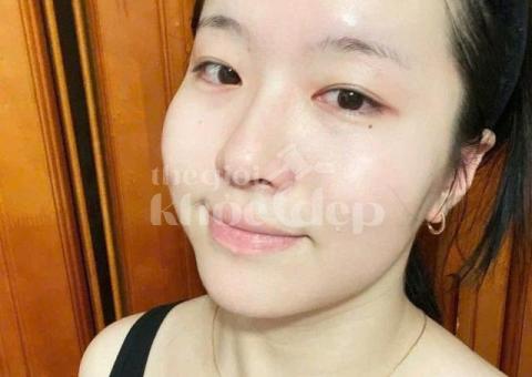 Trị nám hỗn hợp và tàn nhang – Giải pháp công nghệ cao, hiệu quả toàn diện - 3/3