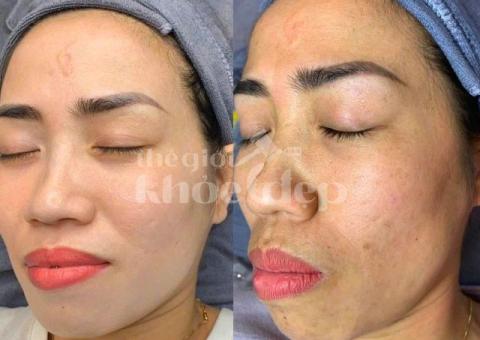 Trị nám do nội tiết tố và stress – Giải pháp công nghệ cao, hiệu quả bền vững - 1/5