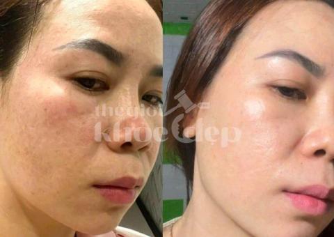 Trị nám do nội tiết tố và stress – Giải pháp công nghệ cao, hiệu quả bền vững - 2/5