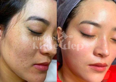 Trị nám do nội tiết tố và stress – Giải pháp công nghệ cao, hiệu quả bền vững - 3/5