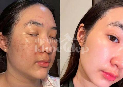 Trị nám do nội tiết tố và stress – Giải pháp công nghệ cao, hiệu quả bền vững - 4/5