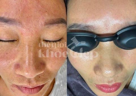 Trị nám do ánh nắng và lão hóa – Giải pháp công nghệ cao, an toàn và hiệu quả - 1/3