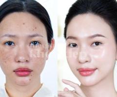 Trị nám sau peel/lột da thất bại – Giải pháp an toàn, phục hồi da sáng khỏe