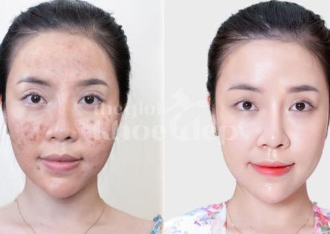 Trị nám sau peel/lột da thất bại – Giải pháp an toàn, phục hồi da sáng khỏe - 2/4