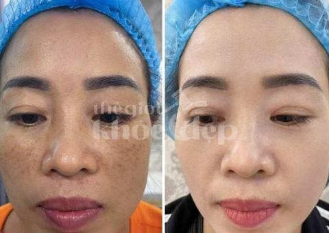 Trị nám sau sinh – Giải pháp an toàn, phục hồi da sáng mịn - 4/4