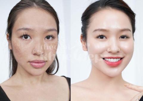 Trị nám da mặt nhẹ – Giải pháp nhanh chóng, an toàn, hiệu quả - 2/3