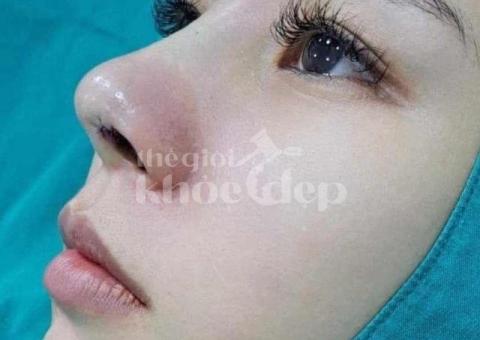 Nâng mũi bán cấu trúc 2025 – Dáng mũi đẹp tự nhiên, an toàn chuẩn y khoa - 3/3
