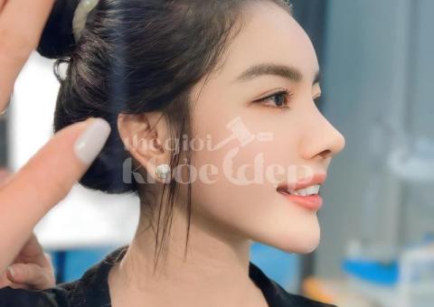 Nâng mũi Revision 2025 – Khắc phục mũi hỏng, sửa biến chứng an toàn - 2/2