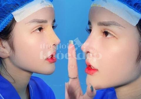 Nâng mũi Demi Line 2025 – Dáng mũi thanh thoát, tự nhiên