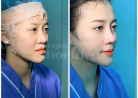 Nâng mũi Sline kết hợp thu gọn cánh mũi 2025 – Dáng mũi hoàn hảo, hài hòa