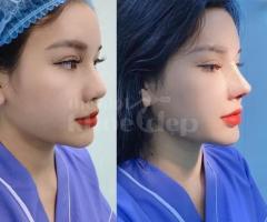 Nâng mũi Hàn Quốc cấu trúc 4D – Dáng mũi chuẩn đẹp, an toàn 2025