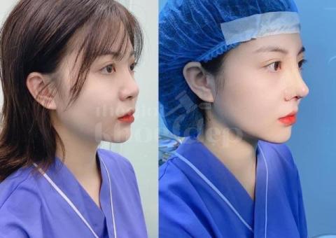 Phẫu thuật nâng mũi đẹp tự nhiên, an toàn – Độc quyền đấu giá tại thegioikhoedep.com