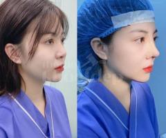 Phẫu thuật nâng mũi đẹp tự nhiên, an toàn – Độc quyền đấu giá tại thegioikhoedep.com
