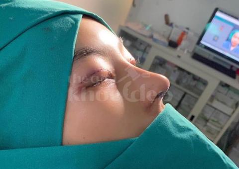 Nâng mũi đẹp chuẩn y khoa – An toàn, tự nhiên, bền vững - 2/7