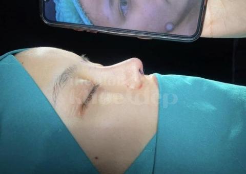 Nâng mũi đẹp chuẩn y khoa – An toàn, tự nhiên, bền vững - 3/7