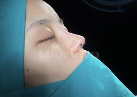 Nâng mũi đẹp chuẩn y khoa – An toàn, tự nhiên, bền vững - 4/7