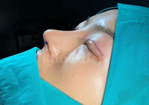 Nâng mũi đẹp chuẩn y khoa – An toàn, tự nhiên, bền vững - 5/7