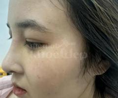 Nâng mũi đẹp tự nhiên, an toàn – Giải pháp hoàn hảo từ bác sĩ uy tín