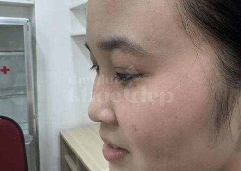 Nâng mũi đẹp tự nhiên, an toàn – Giải pháp hoàn hảo từ bác sĩ uy tín - 3/4