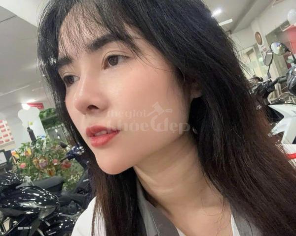 Nâng mũi cấu trúc – Giải pháp cho mũi thấp, đầu mũi to, biến chứng tối thiểu - 3/3