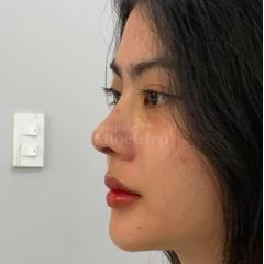 Nâng mũi cấu trúc Hàn Quốc – Dáng mũi thon gọn, thanh tú, chuẩn tỷ lệ vàng