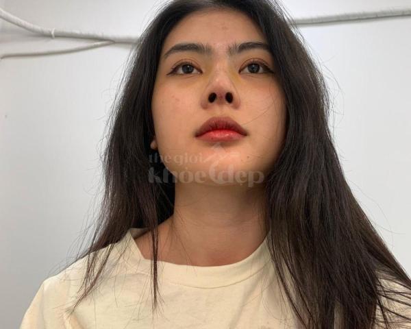 Nâng mũi cấu trúc Hàn Quốc – Dáng mũi thon gọn, thanh tú, chuẩn tỷ lệ vàng - 2/5