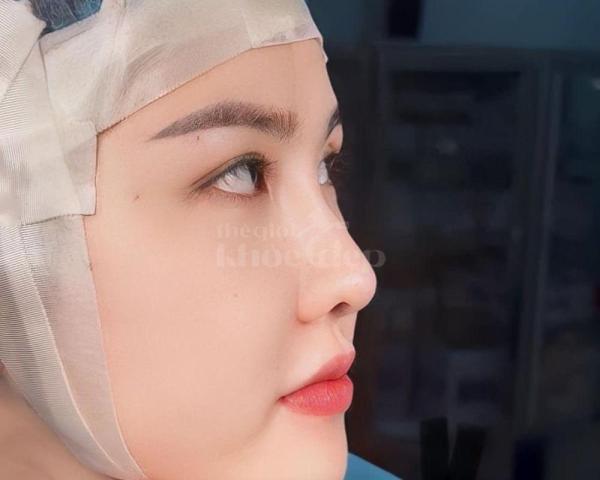 Nâng mũi S-line Ultimate – Sống mũi cao, đầu mũi thanh thoát, gương mặt hài hòa - 1/5