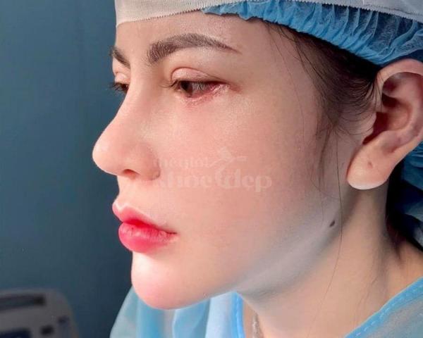 Nâng mũi S-line Ultimate – Sống mũi cao, đầu mũi thanh thoát, gương mặt hài hòa - 4/5
