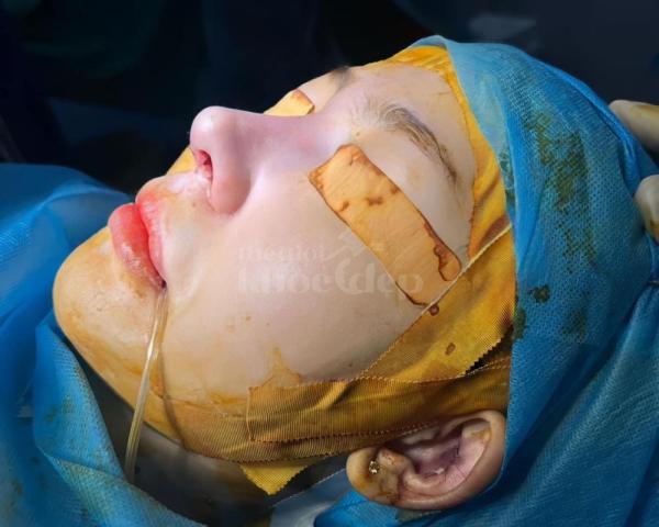 “Nâng mũi đẹp tự nhiên – An toàn tuyệt đối, giá ưu đãi trên thegioikhoedep.com” - 2/7