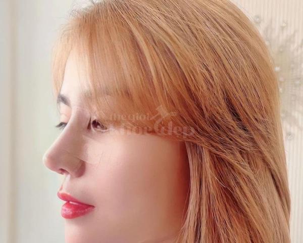 Nâng mũi cấu trúc 4D tự nhiên, an toàn, duy trì bền lâu — thegioikhoedep.com - 3/7