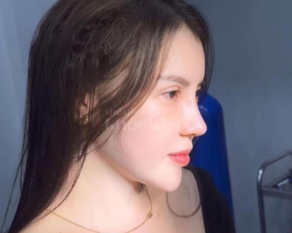 Nâng mũi cấu trúc 4D tự nhiên, an toàn, duy trì bền lâu — thegioikhoedep.com - 7/7