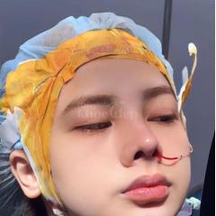 Nâng mũi 4D cấu trúc chuẩn y khoa – Dáng mũi cao tự nhiên, đẹp bền lâu