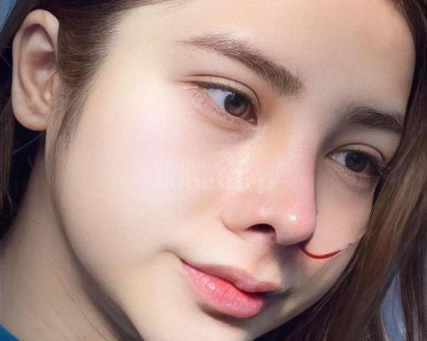 Nâng mũi 4D cấu trúc chuẩn y khoa – Dáng mũi cao tự nhiên, đẹp bền lâu - 3/7