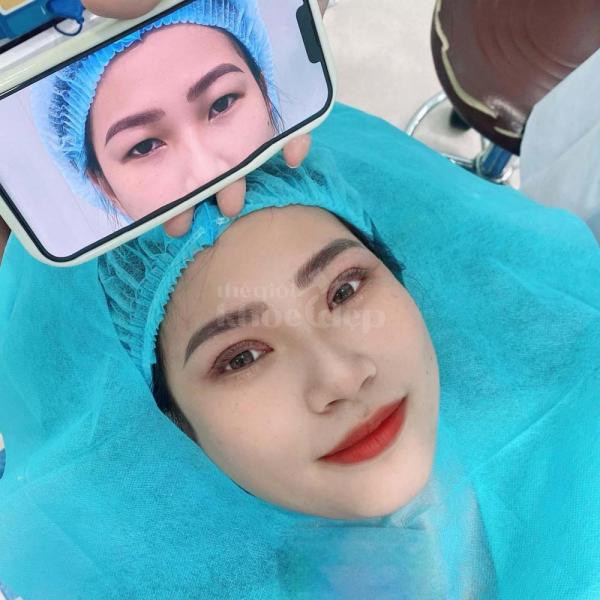 Cắt mí Mini Deep – Giải pháp khắc phục mí lót, mắt nhỏ, mắt buồn - 1/4