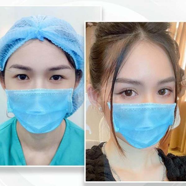 Cắt mí Mini Deep – Giải pháp khắc phục mí lót, mắt nhỏ, mắt buồn - 2/4