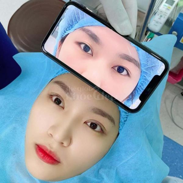 Cắt mí Mini Deep – Giải pháp khắc phục mí lót, mắt nhỏ, mắt buồn - 3/4