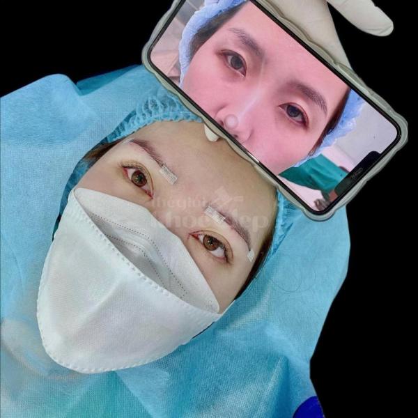 Cắt mí Mini Deep – Giải pháp khắc phục mí lót, mắt nhỏ, mắt buồn - 4/4