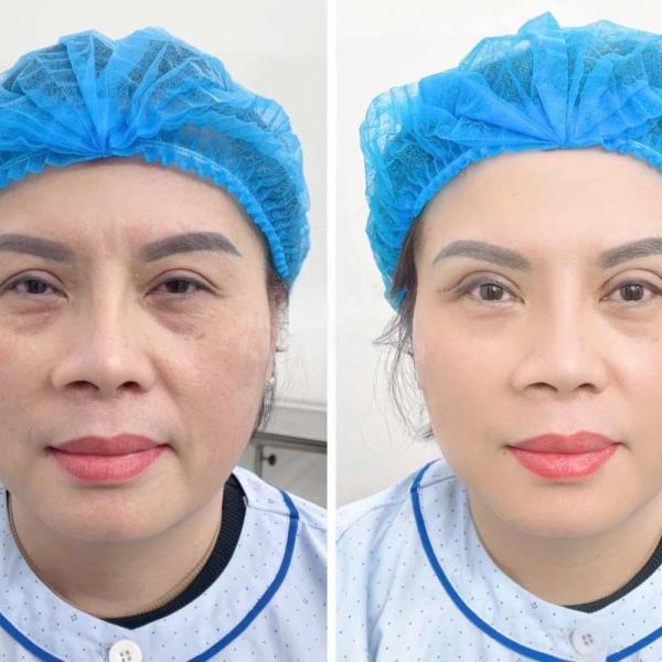 Cắt mí Mini Deep trả lại ánh nhìn tươi trẻ, trẻ hóa toàn diện chỉ sau 60 phút - 4/4