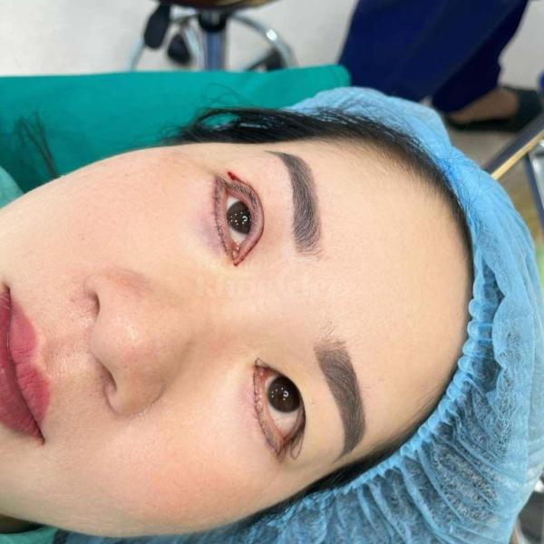 Cắt mí Eyelid Design Hàn Quốc – Công nghệ mí tự nhiên, đẹp bền lâu - 2/4