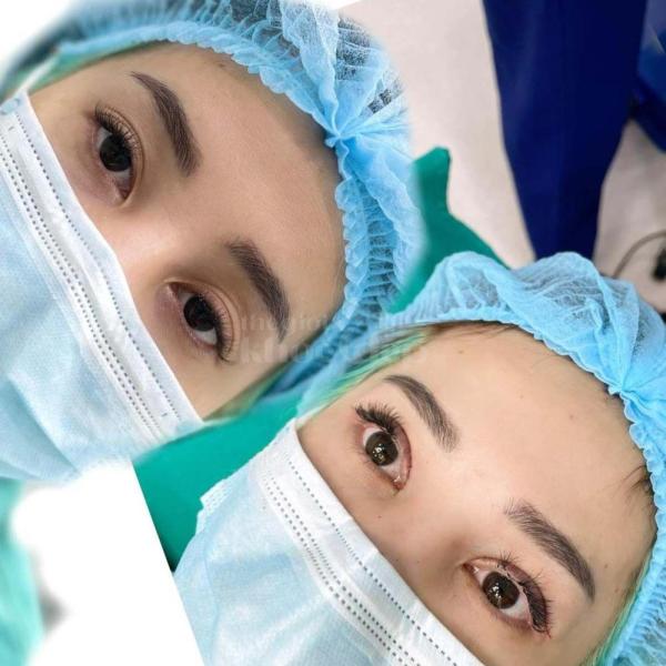 Cắt mí Eyelid Design Hàn Quốc – Công nghệ mí tự nhiên, đẹp bền lâu - 3/4