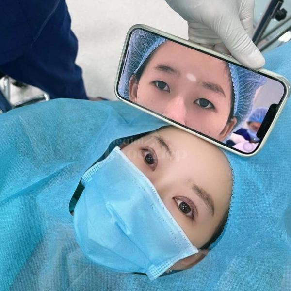 Cắt mí Eyelid Design Hàn Quốc – Công nghệ mí tự nhiên, đẹp bền lâu - 4/4